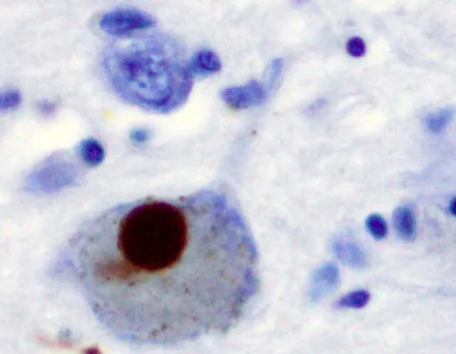  La alfa-sinucleína se muestra con tinción positiva (marrón) en un cuerpo de Lewy en la sustancia negra de un paciente con enfermedad de Parkinson.   