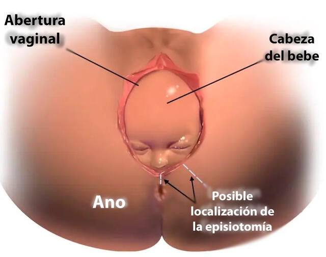 La episiotomía no es una práctica rutinaria recomendada durante el parto. Foto: difusión