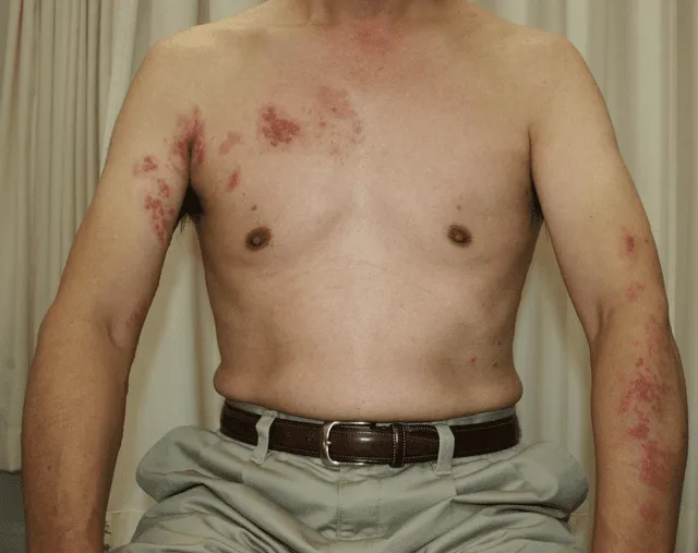  El herpes zóster o culebrilla es causado por el mismo virus que causa la varicela. Foto: Dermatology Online Journal   