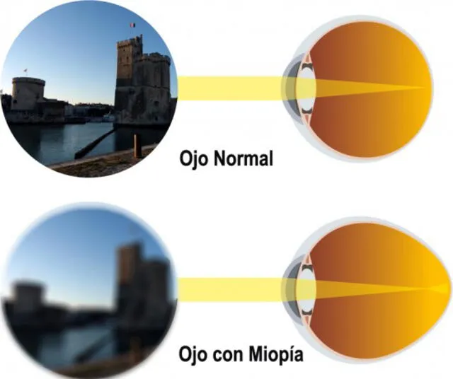 Comparación visual entre un ojo normal y otro con miopía. Foto: Visual Center Madhu