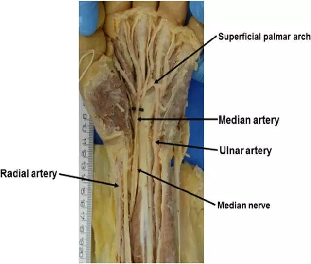 Arteria mediana (Median artery) del brazo de un cadáver. Foto: Journal of Anatomy