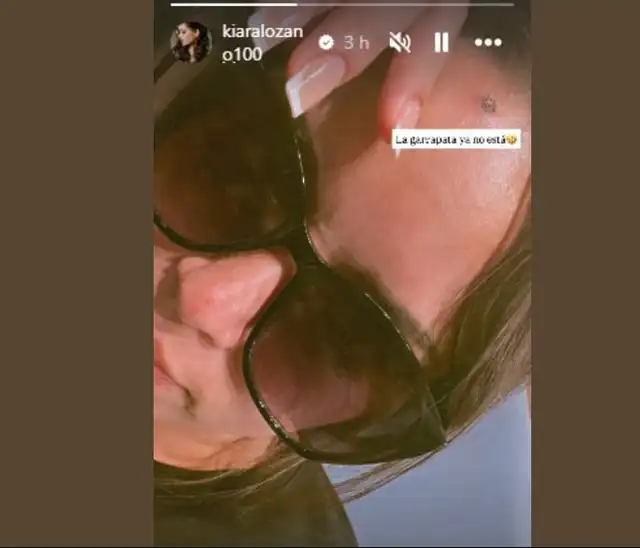 Kiara Lozano mostrando cómo quedó su rostro tras retirarse lunar de carne. Foto: Instagram. Kiara Lozano mostrando cómo quedó su rostro tras retirarse lunar de carne. Foto: Instagram.