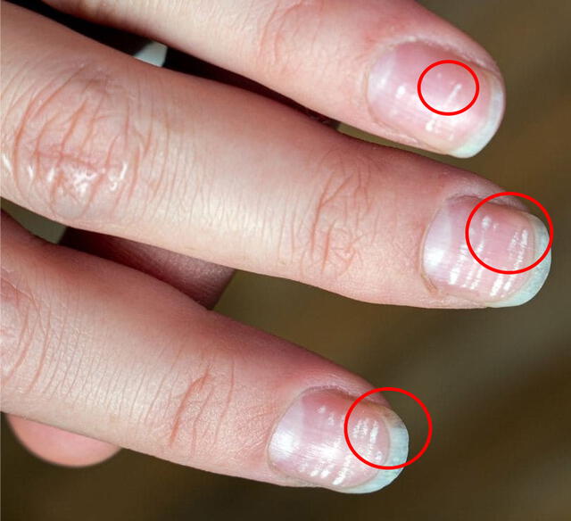  Algunas razones por las que aparecen las manchas blancas en las uñas. Foto: Shutterstock    