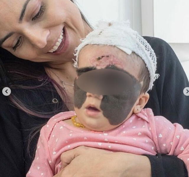 Mamá de la bebé con ‘máscara de Batman’ muestra los primeros resultados del tratamiento [FOTOS y VIDEO] 