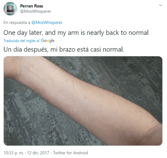 En 2017 Ross mostró cómo su brazo quedó "casi normal" luego de que miles de mosquitos se alimentaran de él. Foto: captura de Twitter