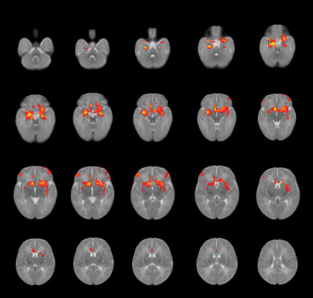 Escáneres cerebrales que muestran patrones de conectividad promedio entre la amígdala y otras regiones en bebés. Foto: Kathryn Manning
