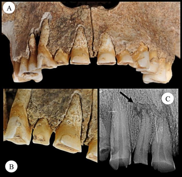 El desgaste dental y la lesión ósea. Foto: Micarelli et al.