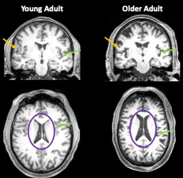 Imágenes del cerebro de una persona de 35 años y otra de 85 años. Las flechas naranjas muestran la materia gris más delgada en el individuo mayor. Foto: Jessica Bernard / CC BY-ND