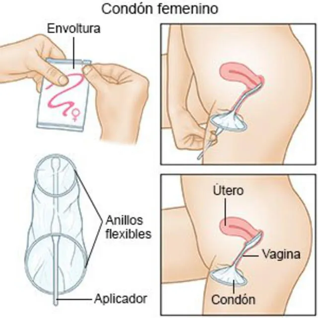 Uso del condón femenino. Foto: Drugs.com