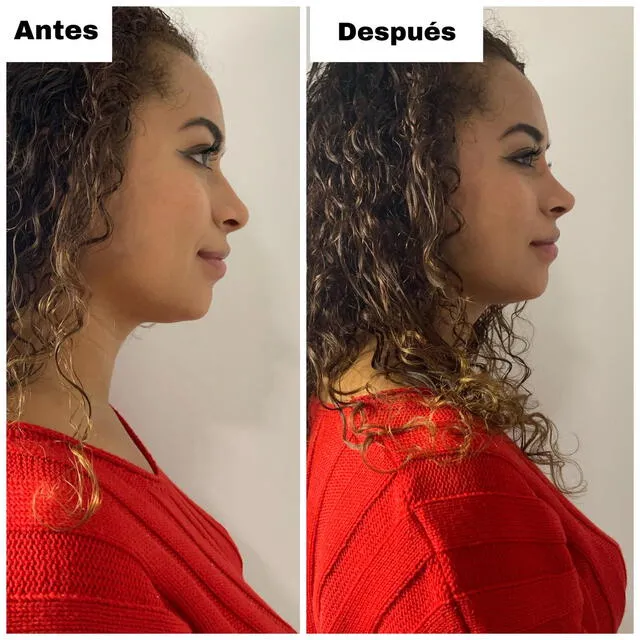  Resultados del procedimiento estético de Ana Claudia Urbina. Foto: Soleil Centro Médico Estético/Facebook<br><br>    
