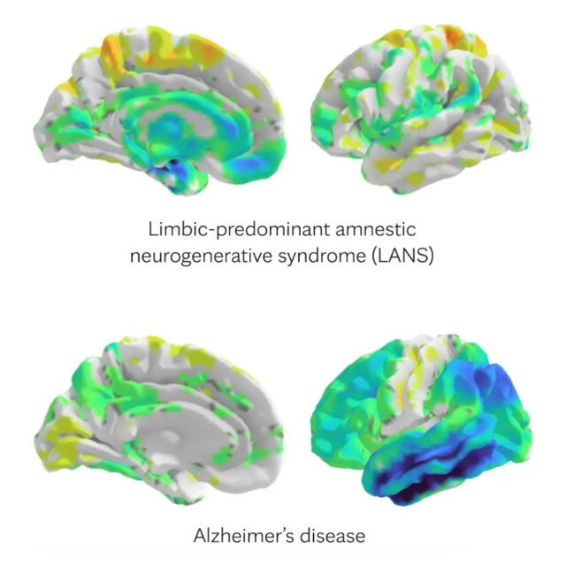  Las diferencias notables incluyen la degeneración en áreas específicas del cerebro. Foto: Mayo Clinic   