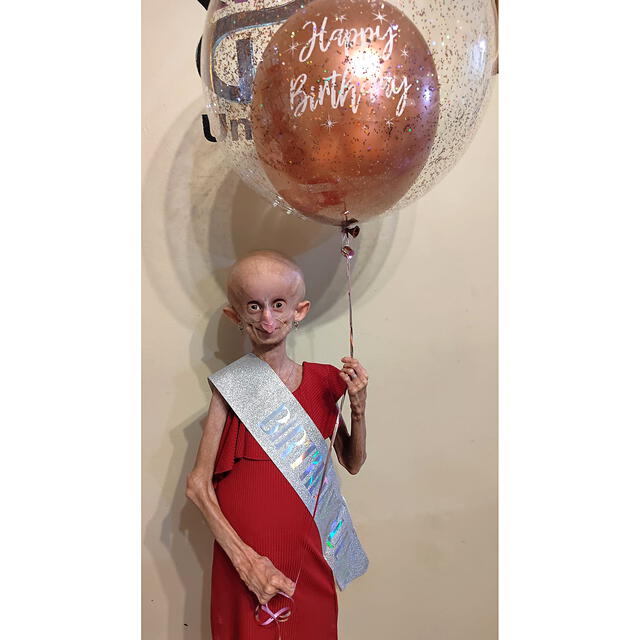 Beandri fue de las pocas personas diagnosticadas con progeria en Sudáfrica. Foto: US magazine   