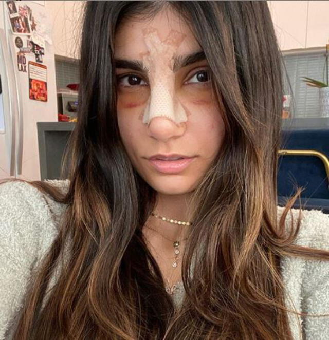 Mia Khalifa muestra su rostro tras la operación. Foto: Instagram