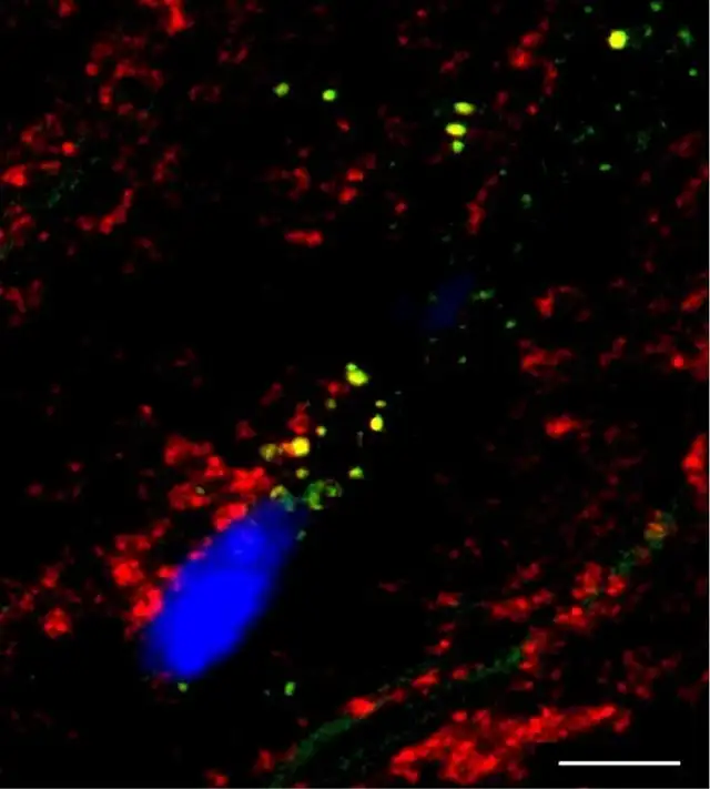  El colesterol puede interferir en el funcionamiento del corazón al acumularse en las mitocondrias de las células cardíacas, según científicos. Foto: DEM<br>    