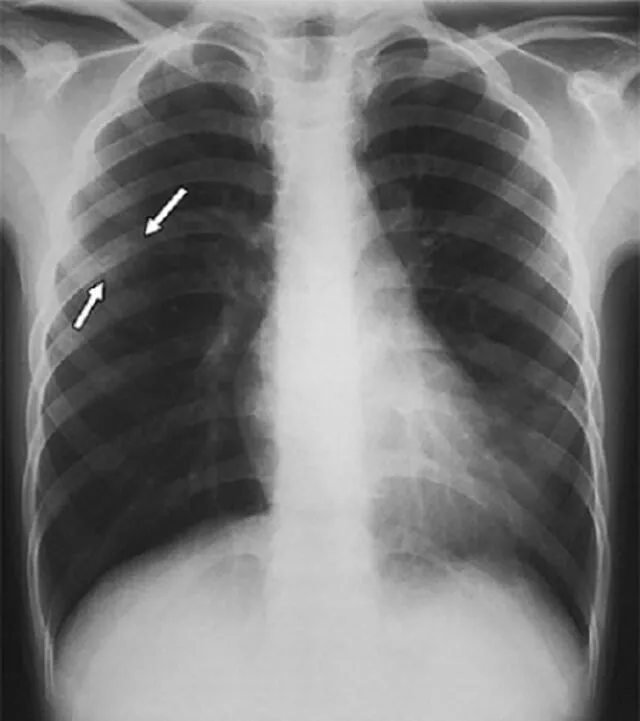 Niño de 8 años con SARS que se presentó en el hospital con antecedentes de fiebre y escalofríos durante 5 días. Foto: Pediatric Pulmonology