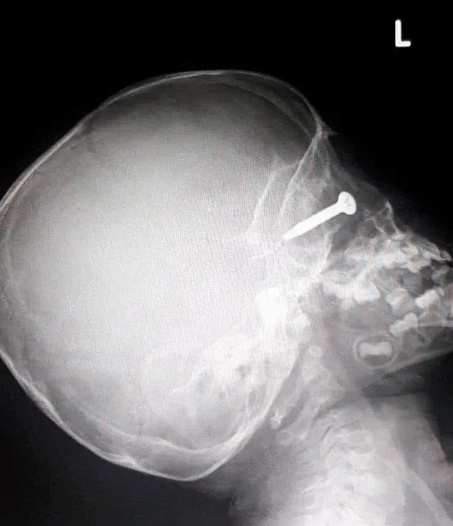 Una imagen de rayos X muestra la profundidad del impacto en el ojo del menor. Foto: ViralPress.