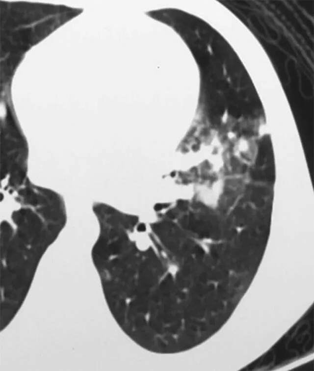 La tomografía computarizada reveló una consolidación mixta del espacio aéreo y la opacidad del vidrio esmerilado en la língula del niño, tras siete días en el hospital. Foto: Pediatric Pulmonology