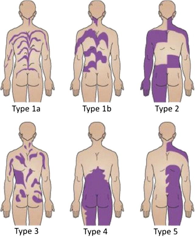  Patrones de mosaicismo en humanos. Foto: Clinics in Dermatology (2011)   