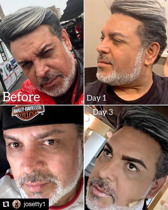 Andrés Hurtado antes y después de su tratamiento facial.