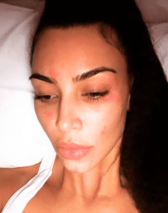Kim Kardashian suele publicar en Instagram cada vez que las manchas rojas aparecen en su cuerpo.