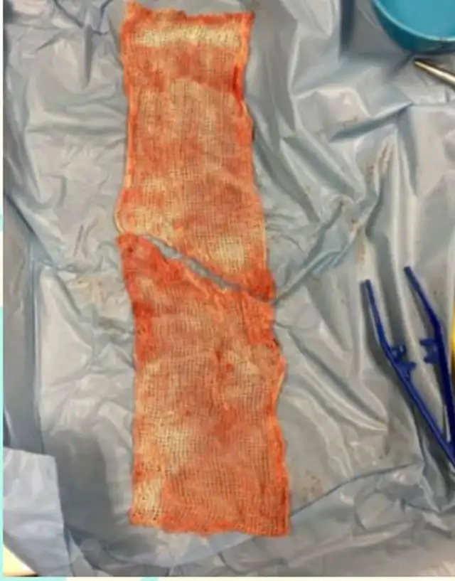 Esta es la gasa que permaneció 2 meses y luego fue extraída del paciente de una operación testicular. Foto: Risk Bulletin Esta es la gasa que permaneció 2 meses y luego fue extraída del paciente de una operación testicular. Foto: Risk Bulletin