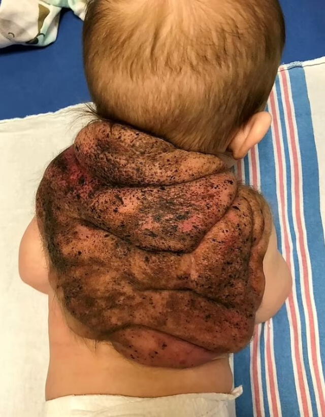 El ‘caparazón’ ocupaba un 75% de su espalda. Foto: Daily Mail El ‘caparazón’ ocupaba un 75% de su espalda. Foto: Daily Mail