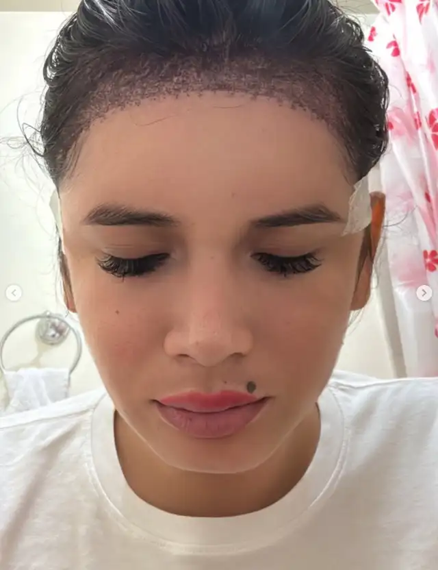 La Uchulú muestra el resultado de su trasplante capilar. Foto: Instagram.   