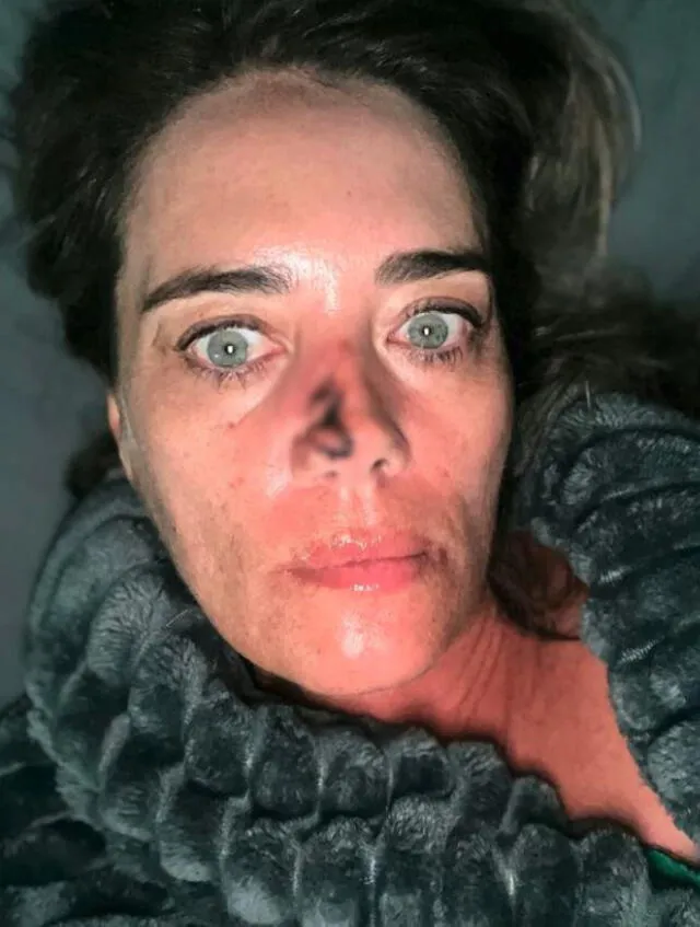 Michelle Davis después de su cirugía para extraer su carcinoma de células basales. Foto: Michelle Davis Michelle Davis después de su cirugía para extraer su carcinoma de células basales. Foto: Michelle Davis