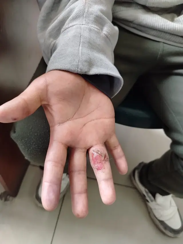 Retenido en Asuntos Sociales y con una herida en su dedo producto de un impacto de perdigón. Foto: Difusión   