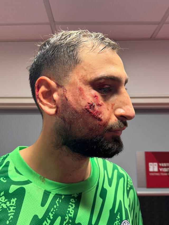 Así quedó el rostro de Donnarumma. Foto: Arthur Perrot   